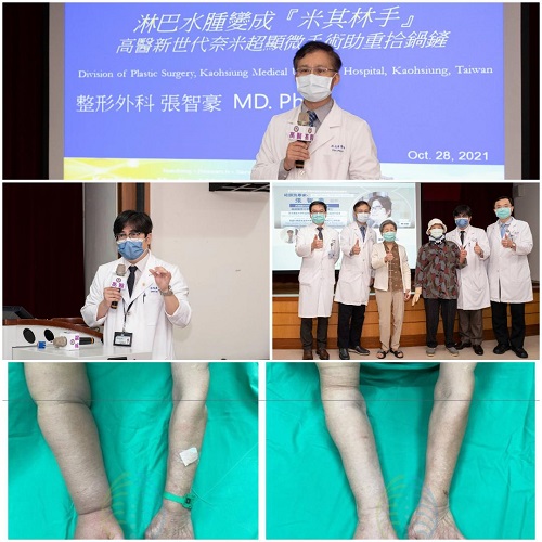 淋巴水腫變成「米其林手」 高醫新世代奈米超顯微手術助重拾鍋鏟