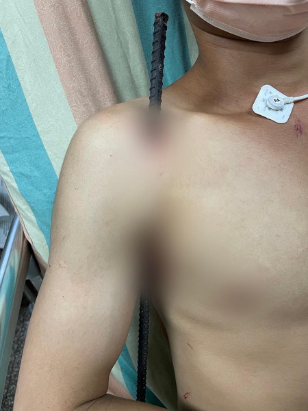 25歲男子遭鋼筋刺入右腋窩 醫師：現場不要拔除鋼筋1