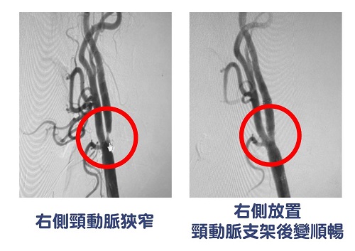 突然看不到 原來是頸動脈狹窄造成 支架置放助恢復1