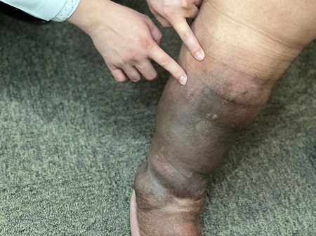 義大癌治療醫院整形外科 超顯微淋巴管靜脈吻合術拯救樹皮人生2