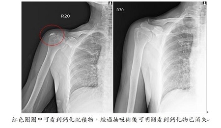 家庭主婦要注意 小心罹患鈣化性肌腱炎1