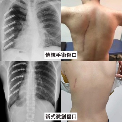 女車禍斷7根肋骨 微創肋骨固定術加速痊癒1