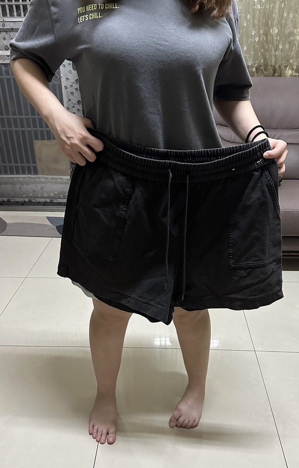 大胃王免開刀 內視鏡減重一天就出院1