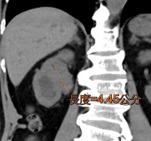 七旬老翁紅尿數月「不痛不理」 頭暈就醫才知罹癌 1