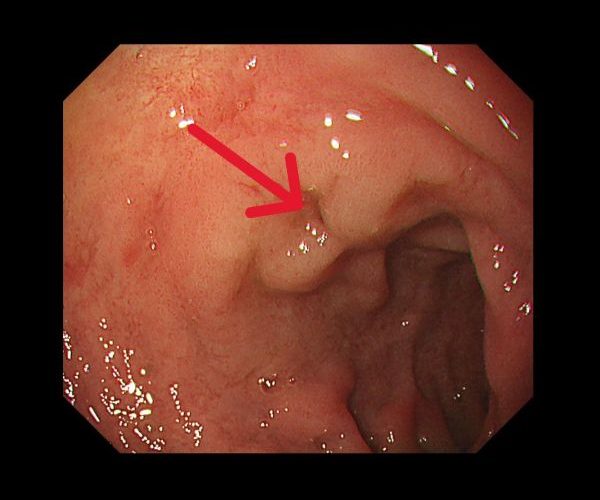 從胃痛到確診第三期胃癌 義大醫療跨團隊陪患者與家屬走過治療關鍵期1