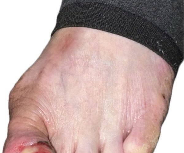 誤以為是甲溝炎竟藏「皮膚癌之冠」高醫整外精準揪出「惡性黑色素瘤」 跨團隊守護化解致命危機1