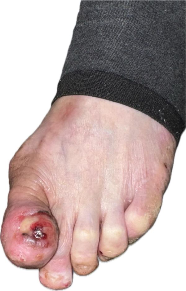 誤以為是甲溝炎竟藏「皮膚癌之冠」高醫整外精準揪出「惡性黑色素瘤」 跨團隊守護化解致命危機1